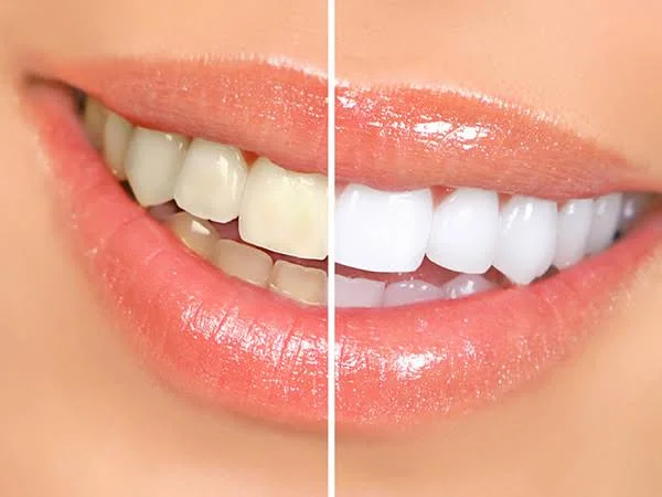 Sorriso estético