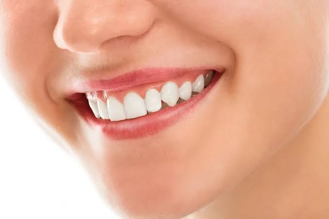 Facetas de porcelana