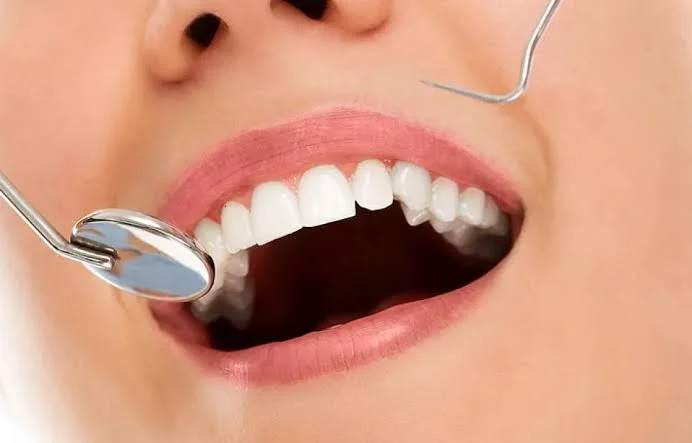 Alinhador Invisalign