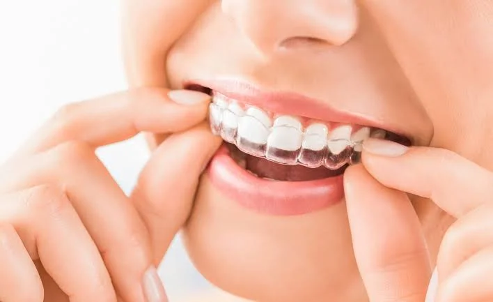 Paciente encaixando um alinhador transparente nos dentes de cima